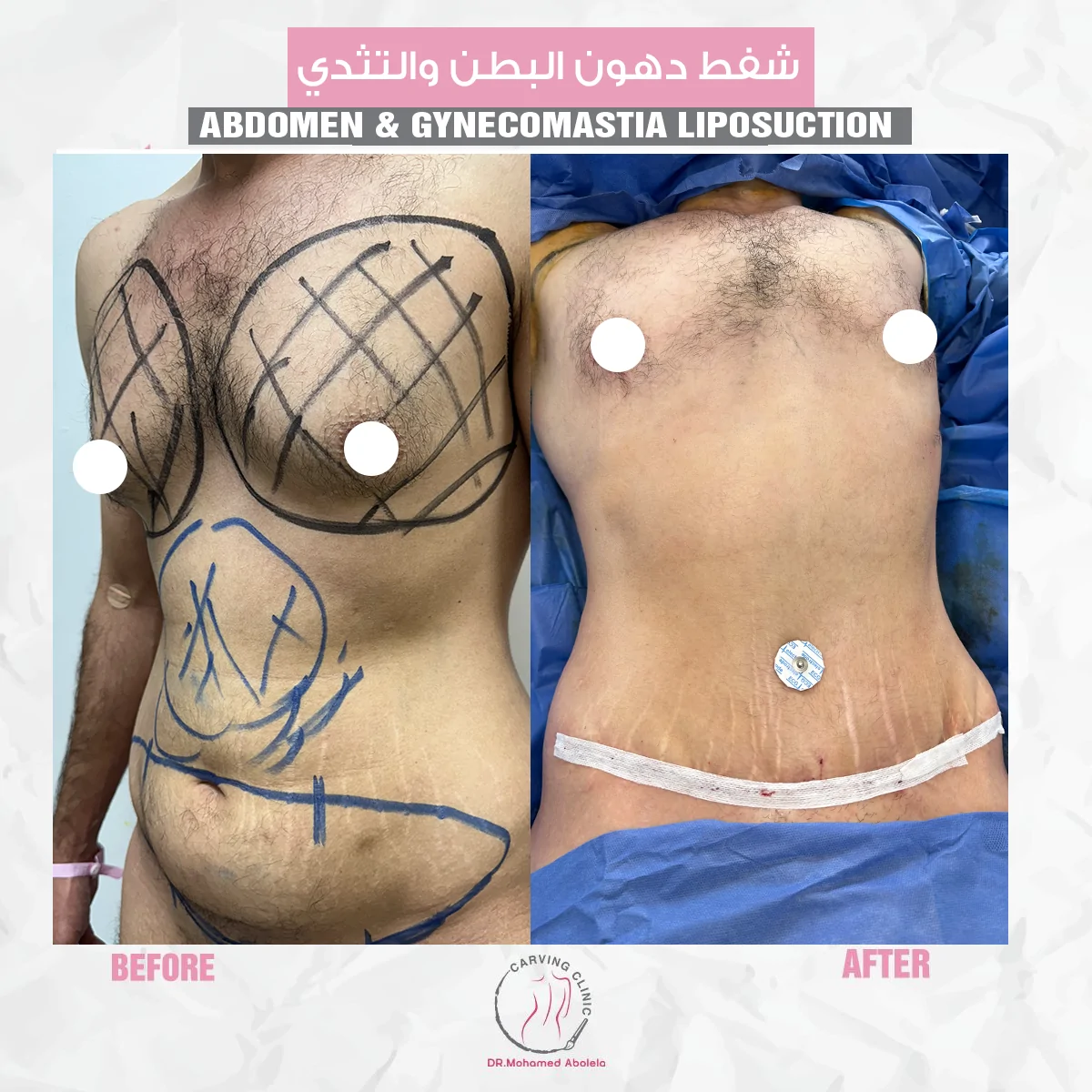 شفط دهون البطن والثدي للرجال..