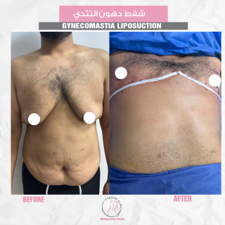 شفط دهون التثدي