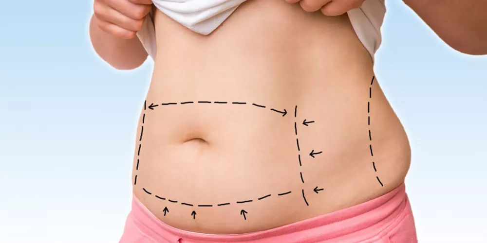 علامات فشل عملية شفط الدهون