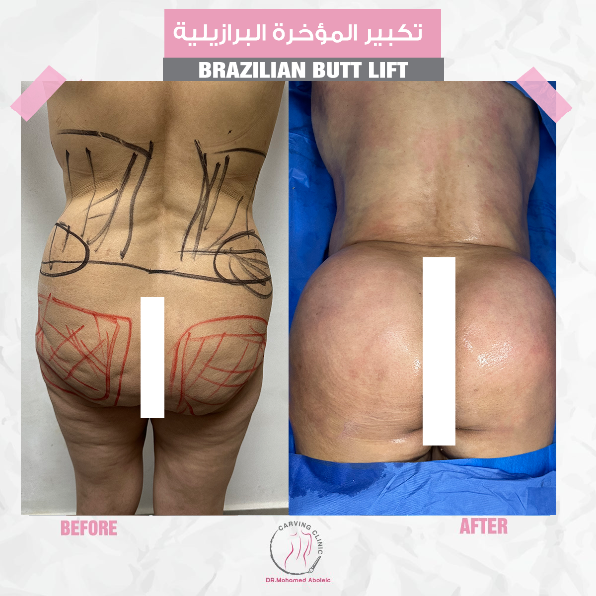 نتائج تكبير المؤخرة