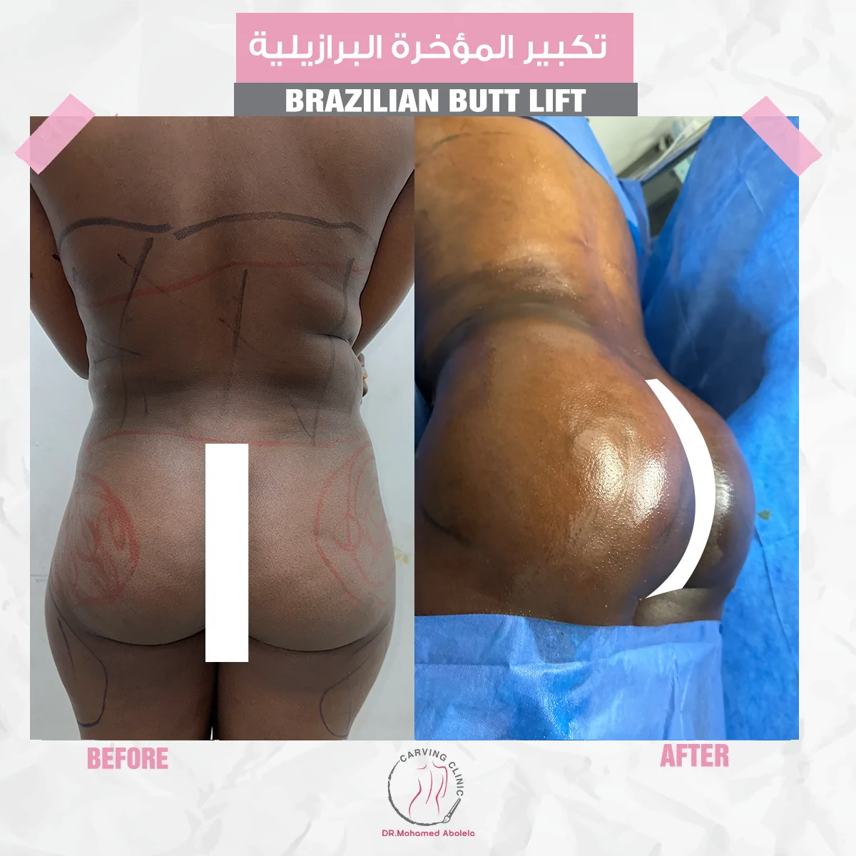 نتائج تكبير المؤخرة