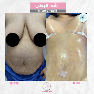 نتائج عملية شد البطن