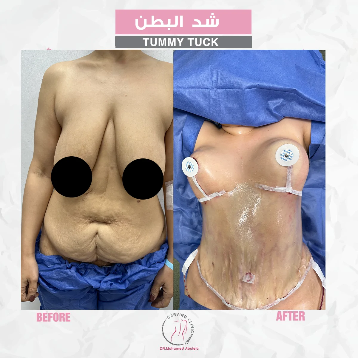 نتائج عملية شد البطن