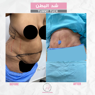 نتائج عملية شد البطن