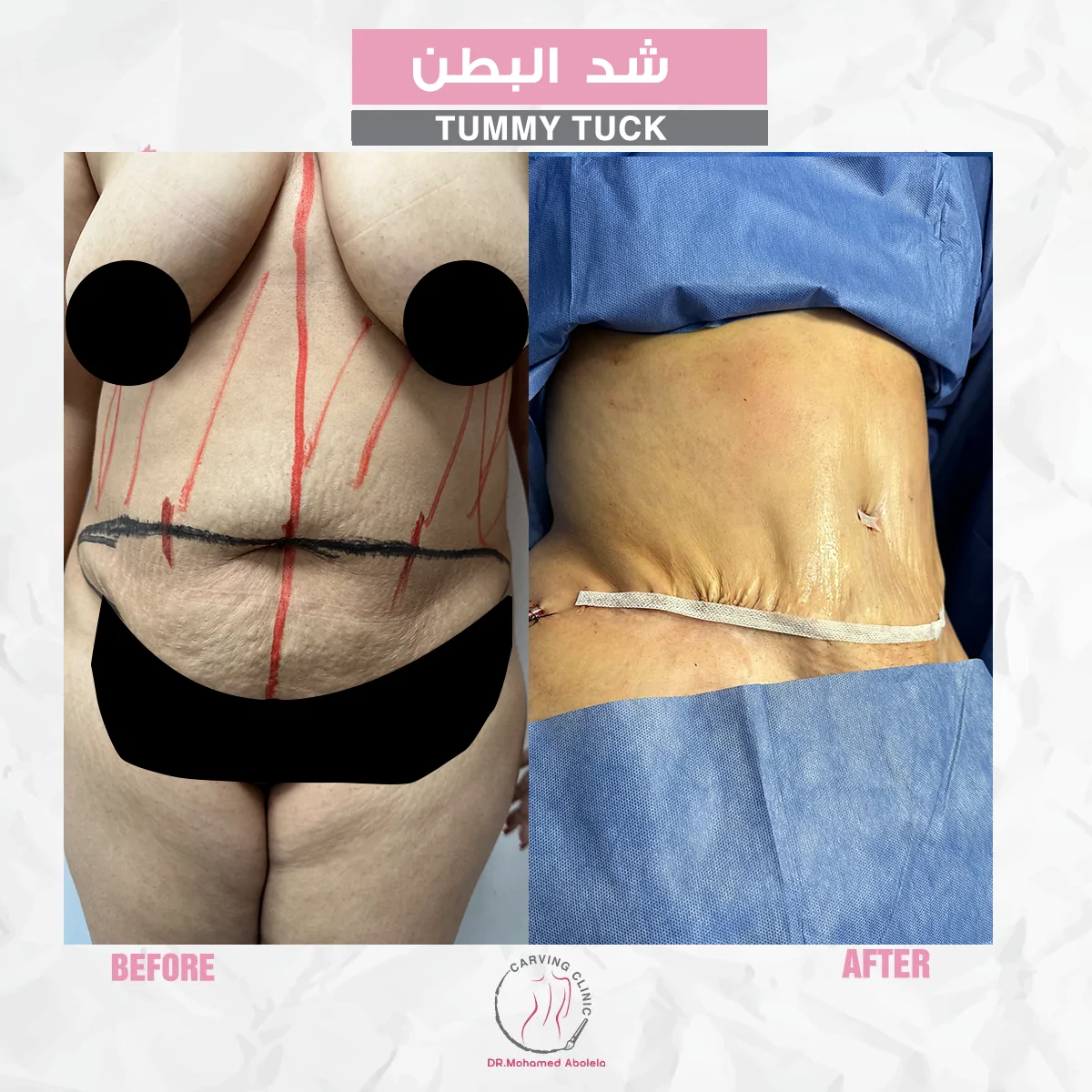 نتائج عملية شد البطن