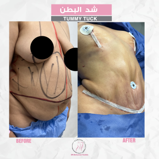 نتائج عملية شد البطن