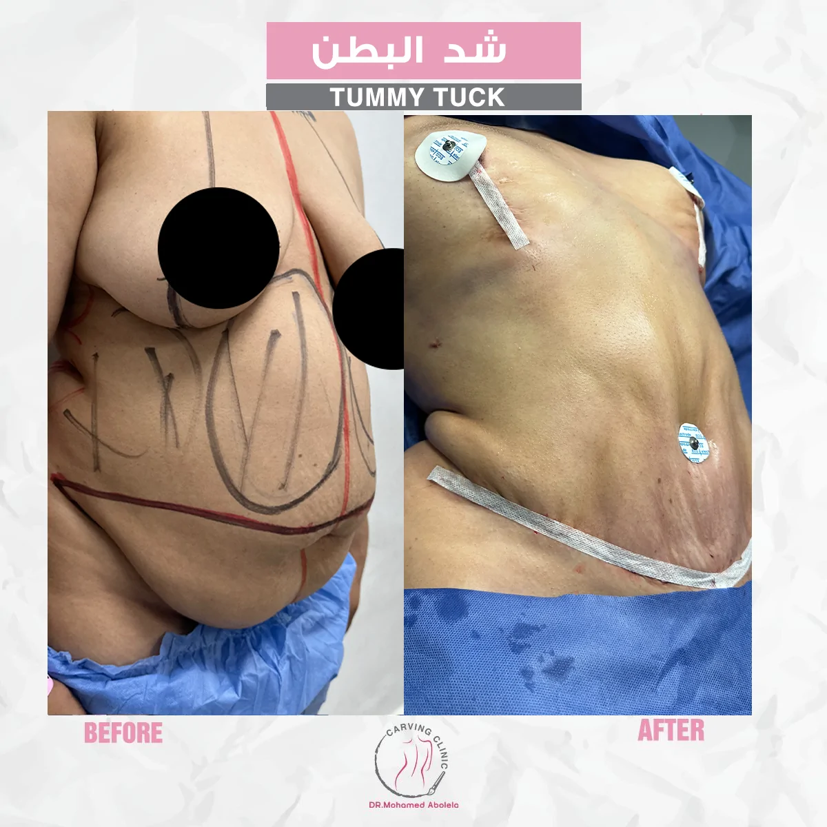 نتائج عملية شد البطن