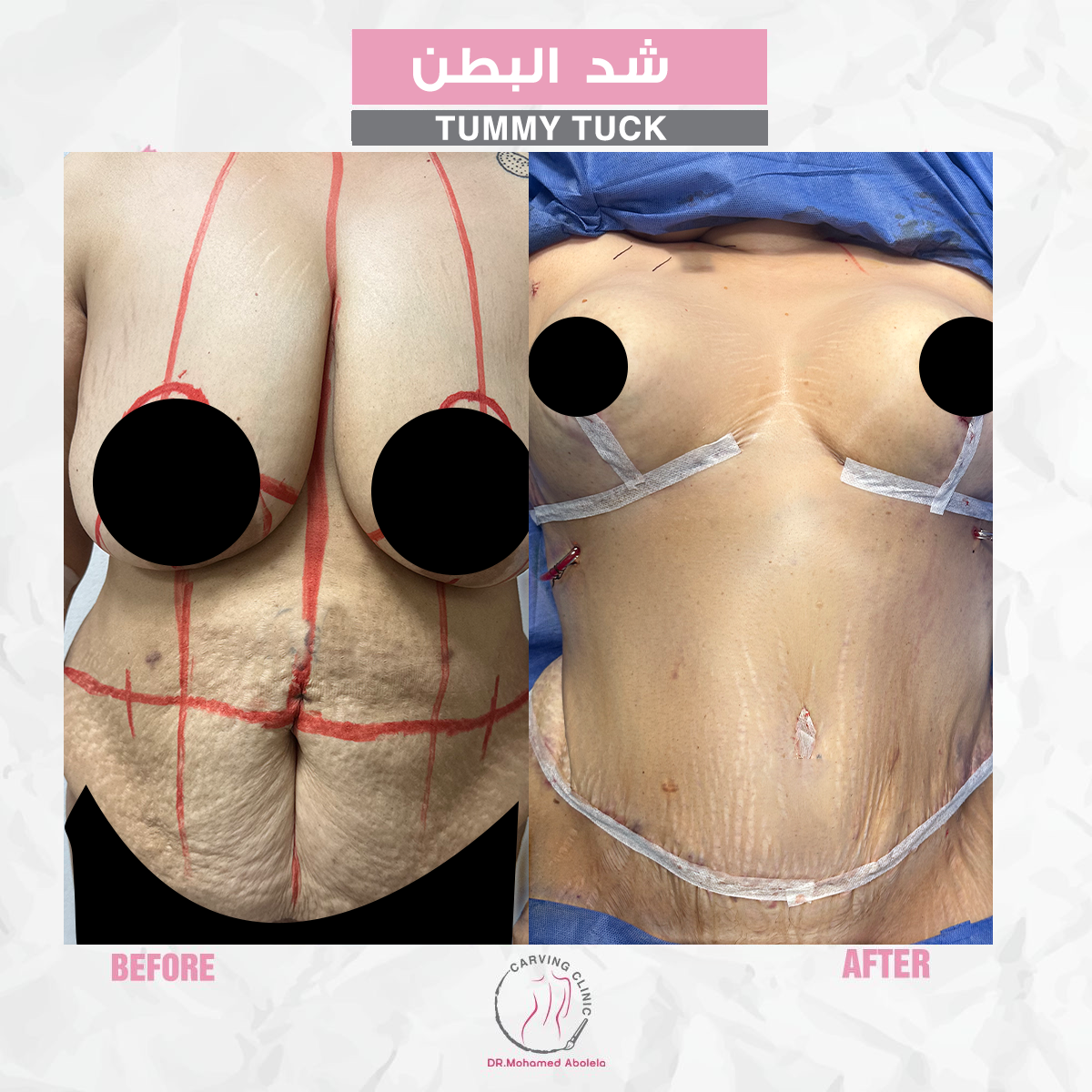 نتائج عملية شد البطن