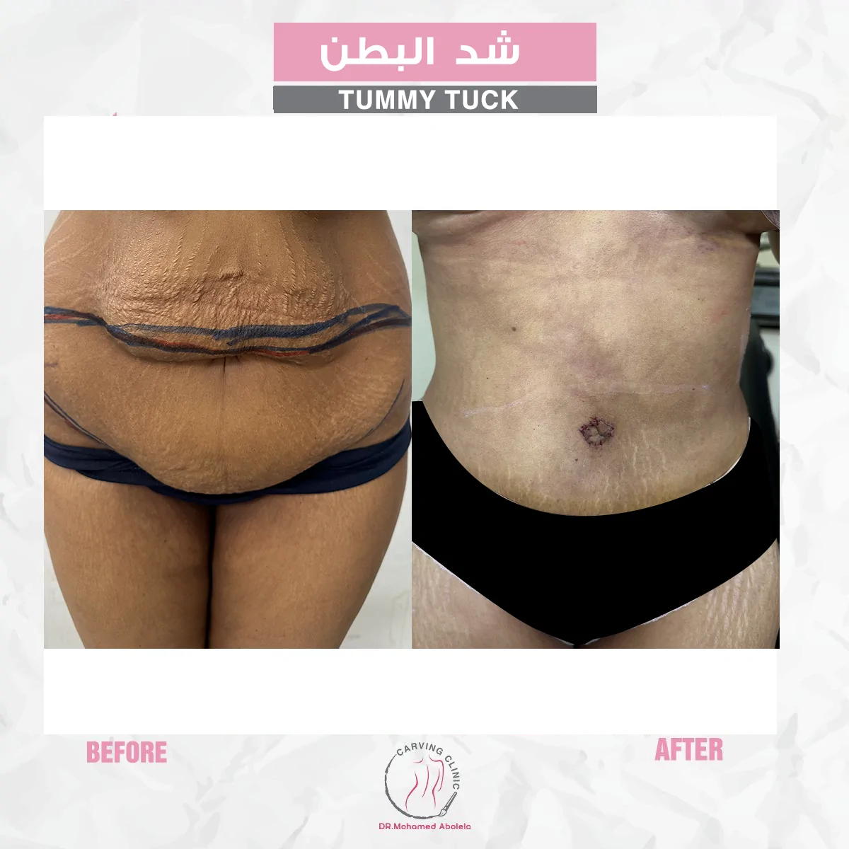 نتائج عملية شد البطن