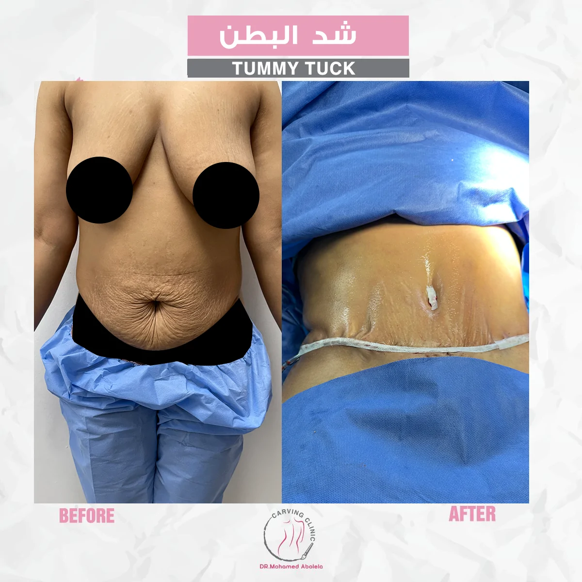 نتائج عملية شد البطن