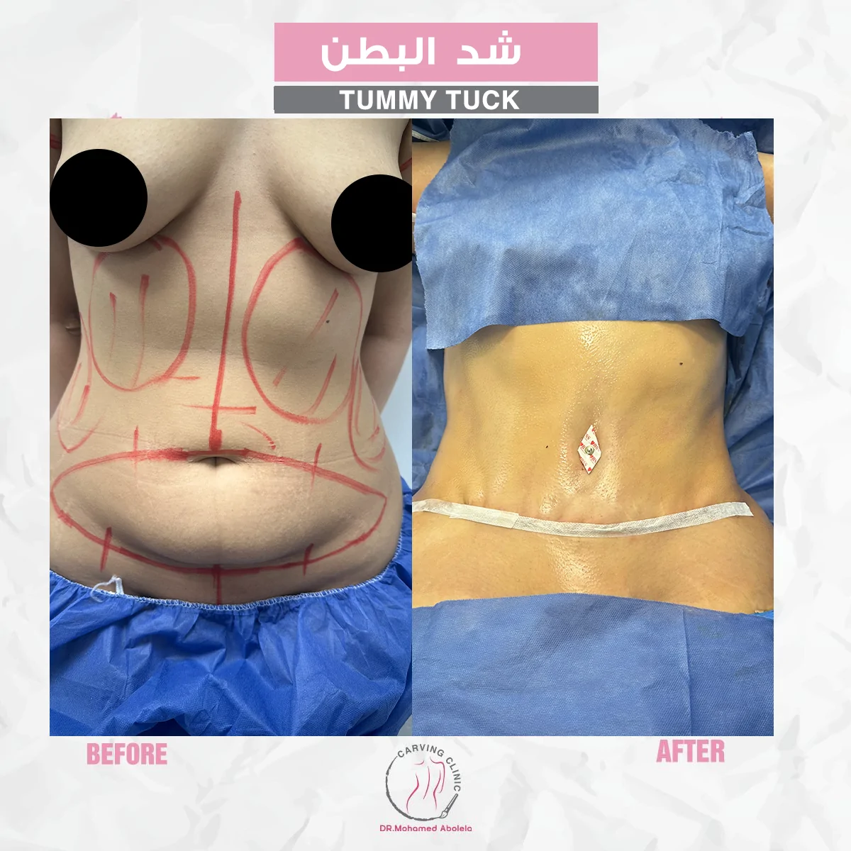 نتائج عملية شد البطن