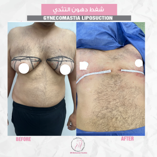 نتائج شفط دهون التثدي