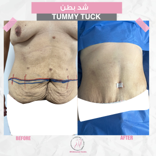 نحت الجسم | التكلفة والنتائج بالصور 4 نتائج عمليات شد البطن