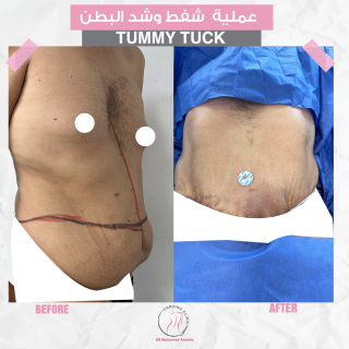 نحت الجسم | التكلفة والنتائج بالصور 2 نتائج شفط دهون البطن