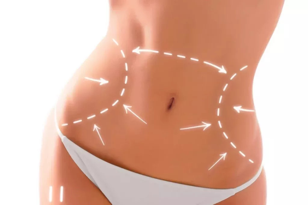 10 أشياء يجب معرفتها عن شفط الدهون قبل وبعد قبل اتخاذ القرار 3 موانع إجراء عملية شفط الدهون