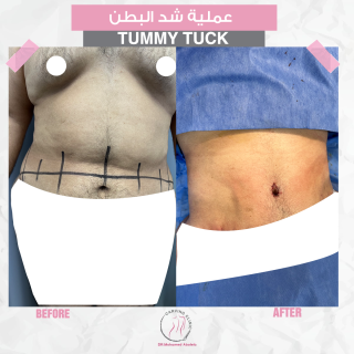 نحت الجسم | التكلفة والنتائج بالصور 3 نتائج عمليات شد البطن