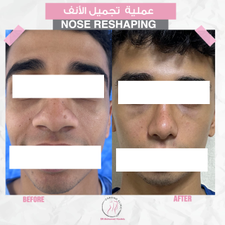 نتائج عمليات تجميل الأنف
