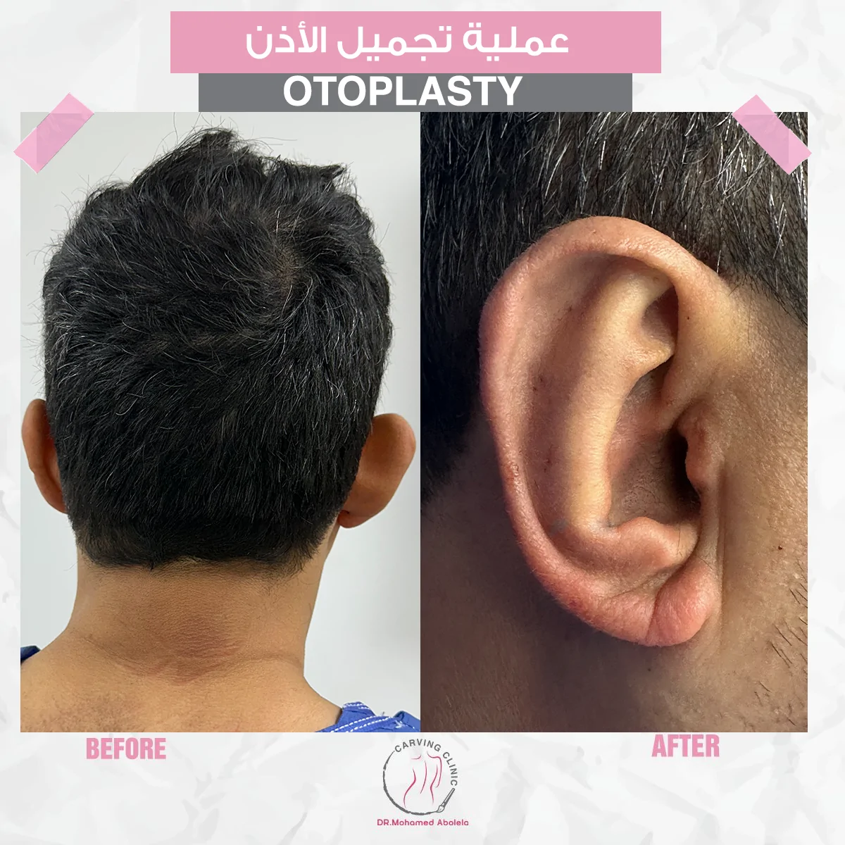 نتائج عمليات تجميل الأذن