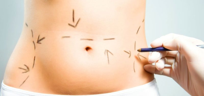 هل يمكن إجراء عمليات شفط الدهون مجاناً؟