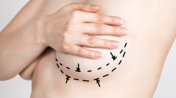 شد ترهلات الثدي بالليزر