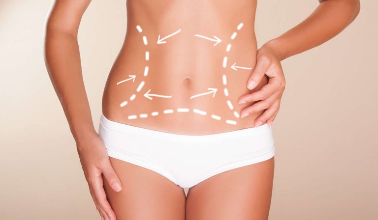 شفط الدهون بالليزر (Laser Lipolysis)