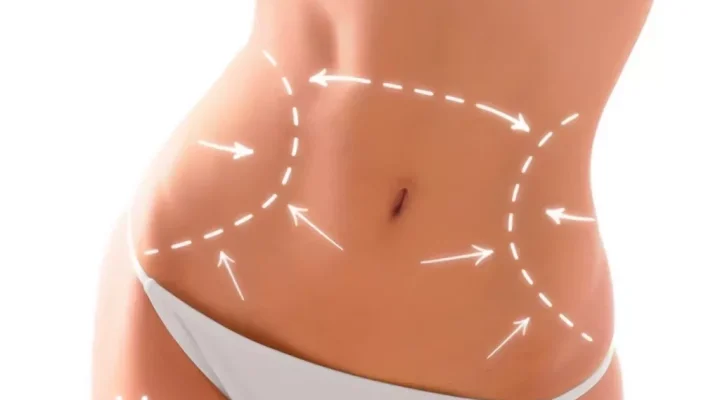 شفط دهون البطن والخصر