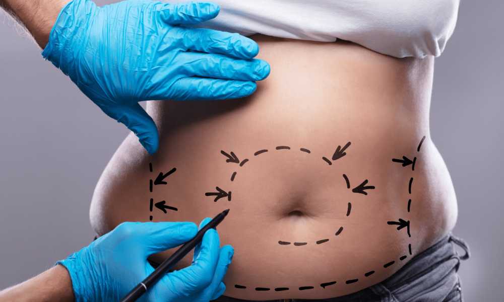 شفط الدهون بحقن السوائل (Tumescent Liposuction)