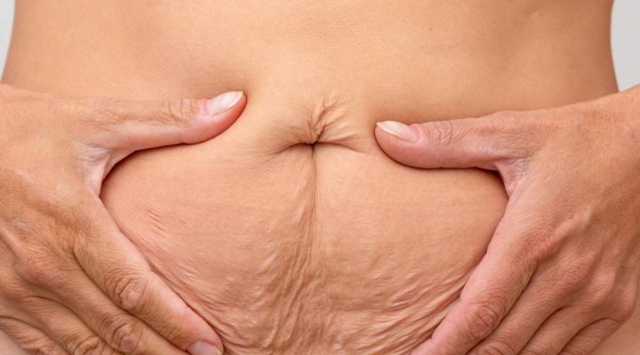 علاج ترهلات الجلد بعد التخسيس