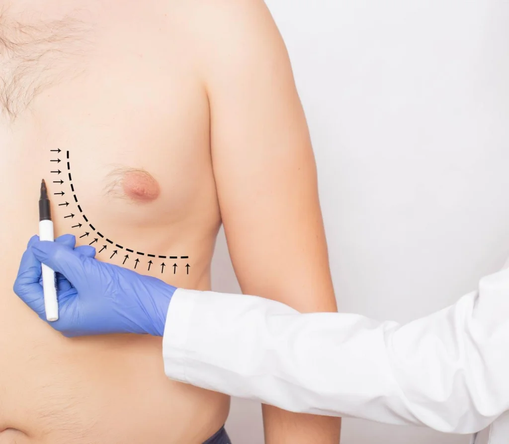 7 حقائق مهمة عن اضرار عملية التثدي عند الرجال |كارفينج كلينك 3 عيوب عملية التثدي عند الرجال