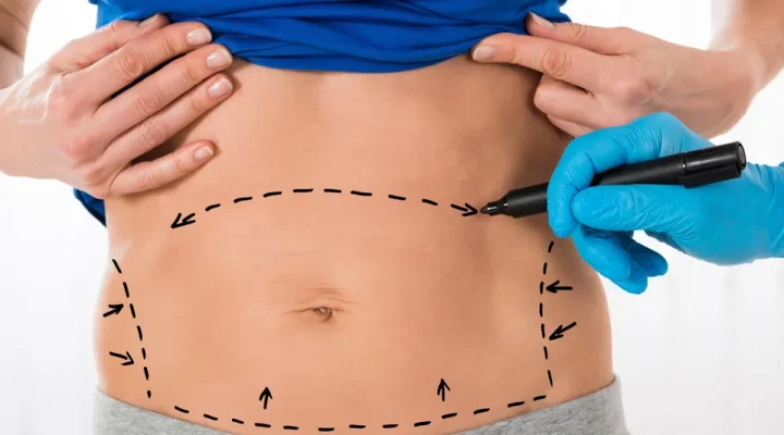 عملية شد البطن بالصور