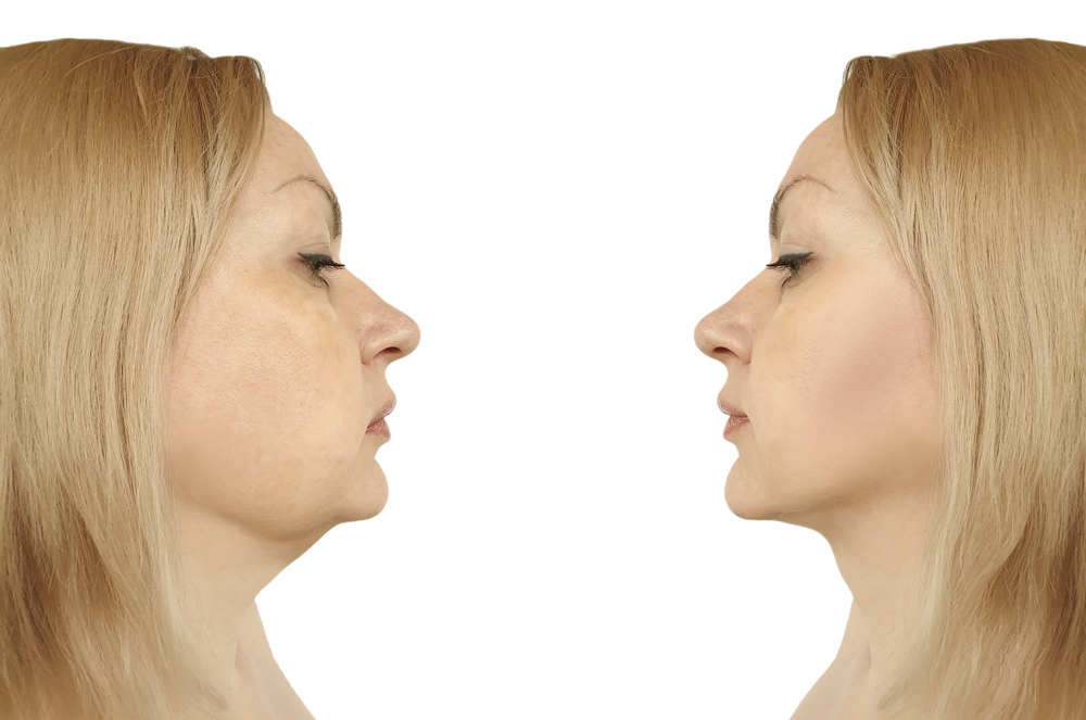 Ultherapy في علاج الذقن المزدوجة