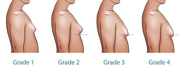 درجات التثدي عند الرجال بالصور