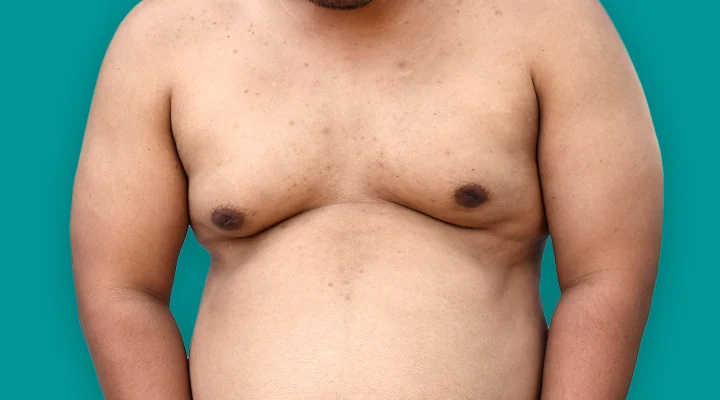 انتفاخ الحلمتين عند الرجل58