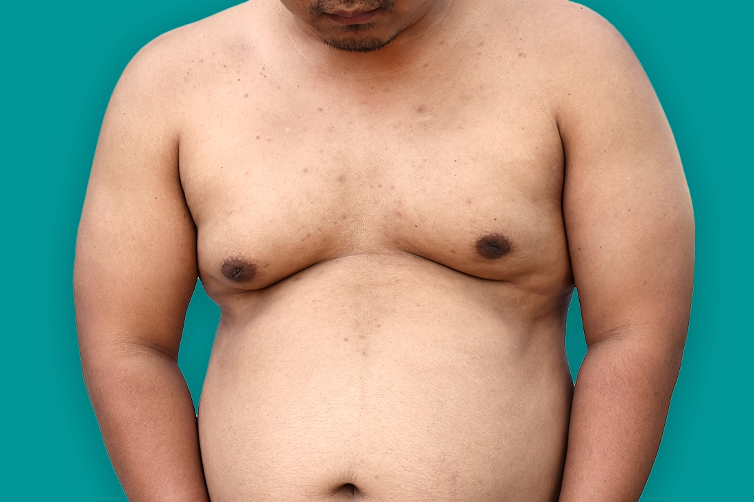 انتفاخ الحلمتين عند الرجل58