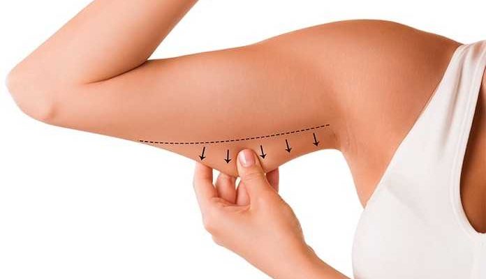 فترة التعافي بعد عملية شد الذراعين 1 بعد عملية شد الذراعين