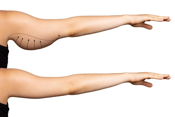 بعد عملية شد الذراعين