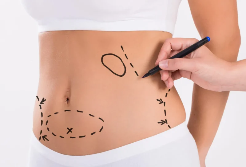 الفرق بين نحت الجسم بدون جراحة وشفط الدهون