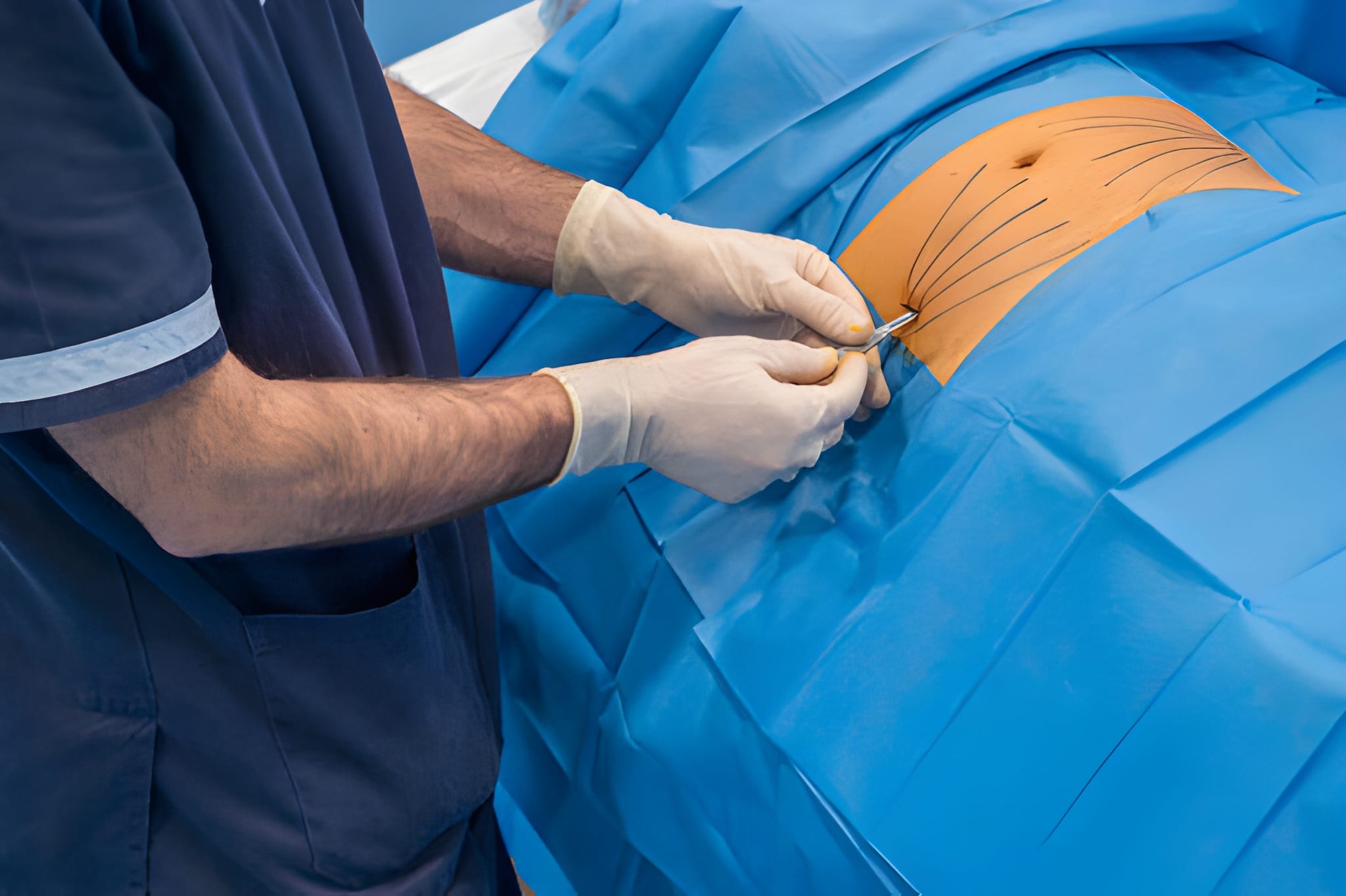 عملية شفط الدهون بالفيزر 2 المرشحون لشفط الدهون بالفيزر