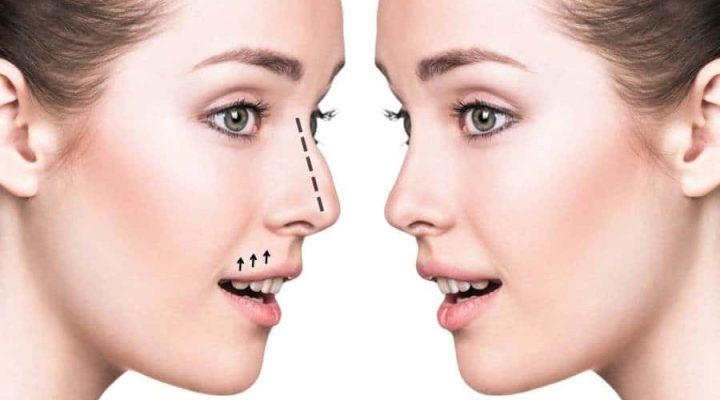 بوتكس تصغير الأنف بدون تدخل جراحي في كارفنج كلينك 6 بوتكس تصغير الأنف