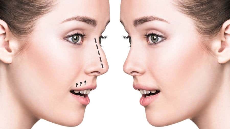 بوتكس تصغير الأنف بدون تدخل جراحي في كارفنج كلينك 1 بوتكس تصغير الأنف