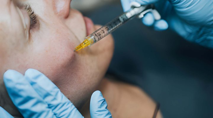 تجربتي مع فيلر الخدود