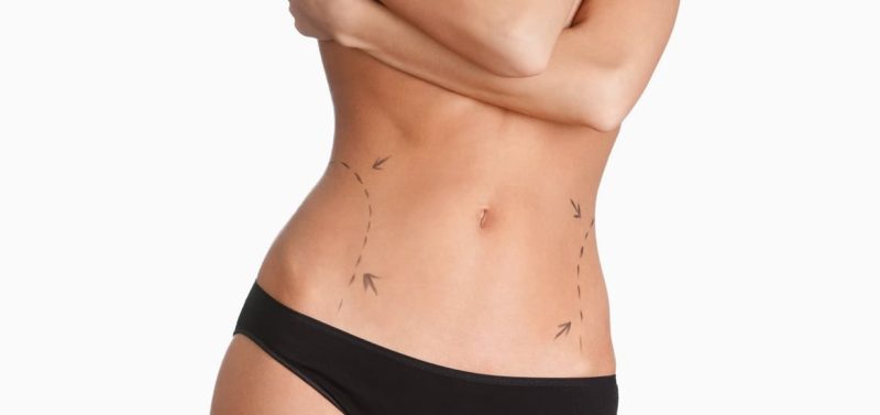 شفط الدهون بالموجات فوق الصوتية