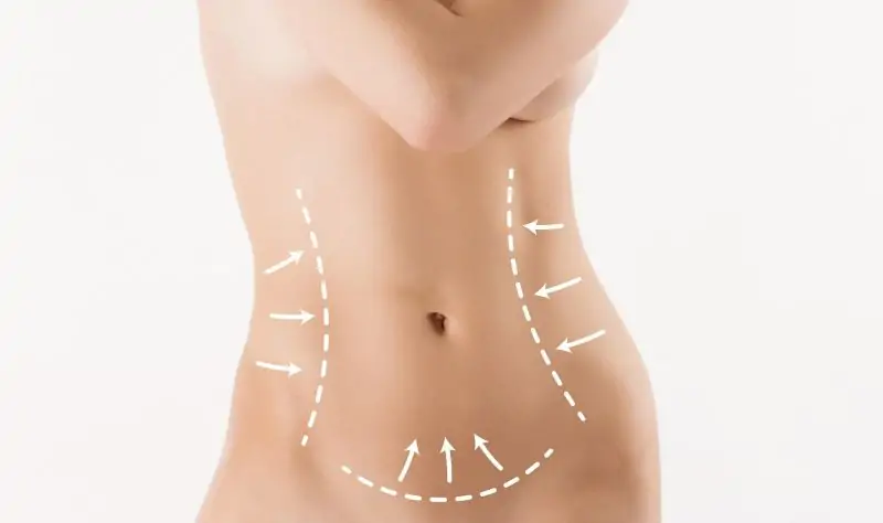 التحفيز الكهربائي للعضلات