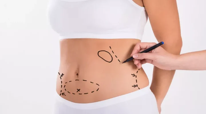 الفرق بين شد البطن وشفط الدهون وأيهما أفضل؟ 10 شد البطن وشفط الدهون