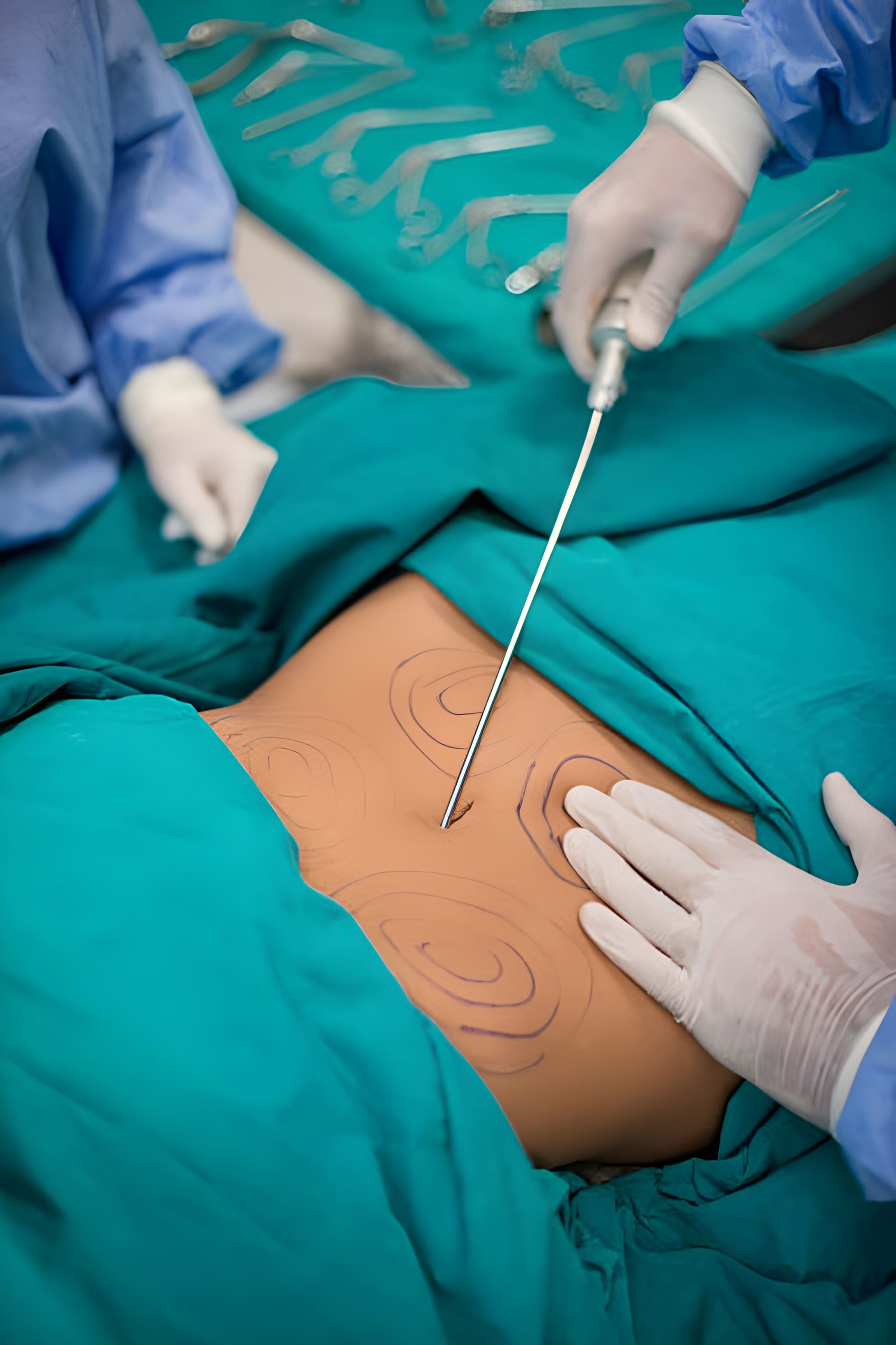 عملية شفط الدهون بالفيزر 1 عملية شفط الدهون بالفيزر