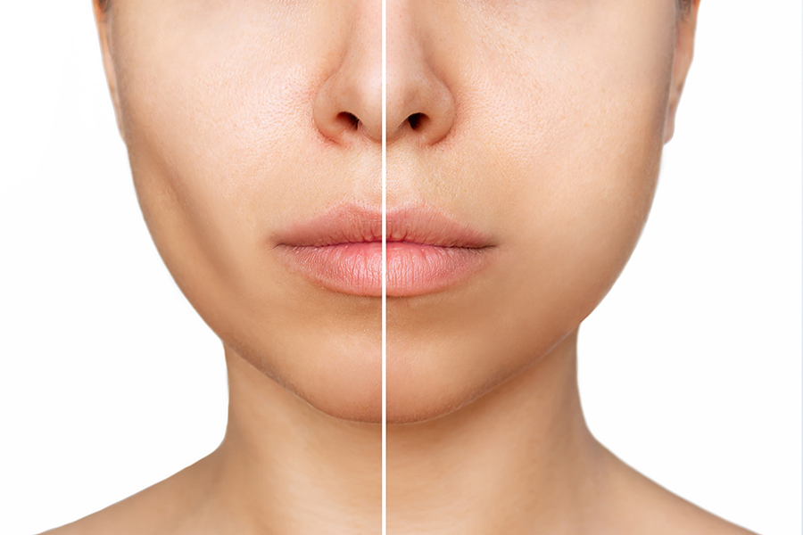 فيلر الخدود قبل وبعد