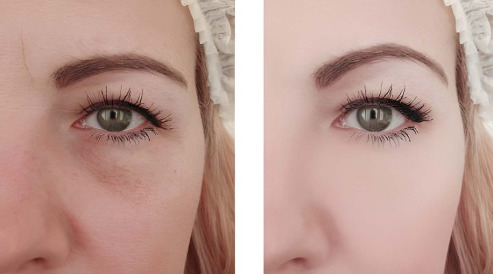 نتائج إبرة النضارة