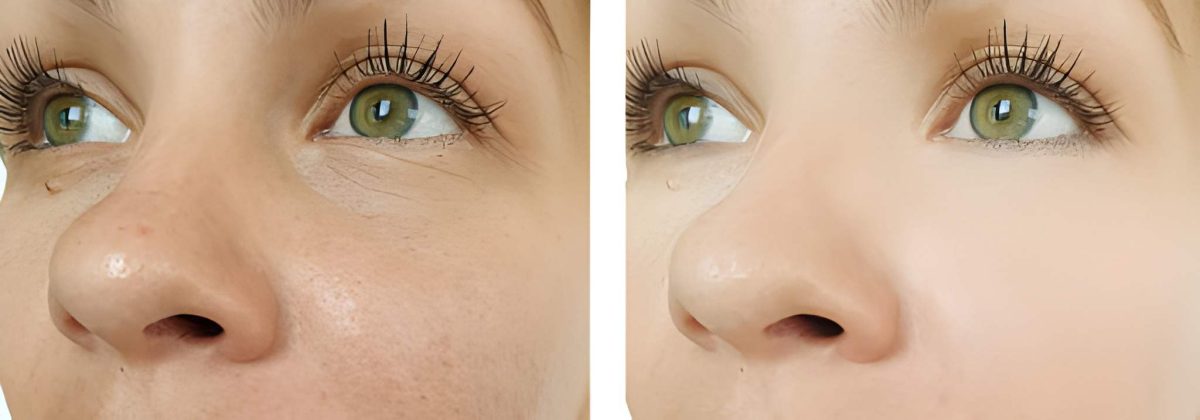 نتائج إبرة النضارة