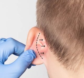 الأذن الخفاشية عند الأطفال