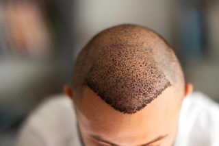 هل زراعة الشعر تسبب السرطان